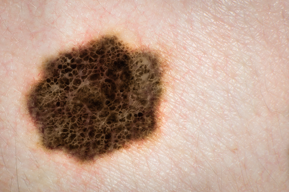 Acral Lentiginous Melanoma