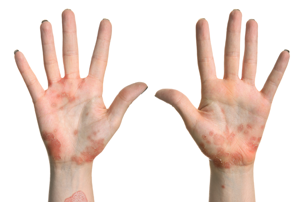 Eczema on the hands and wrists