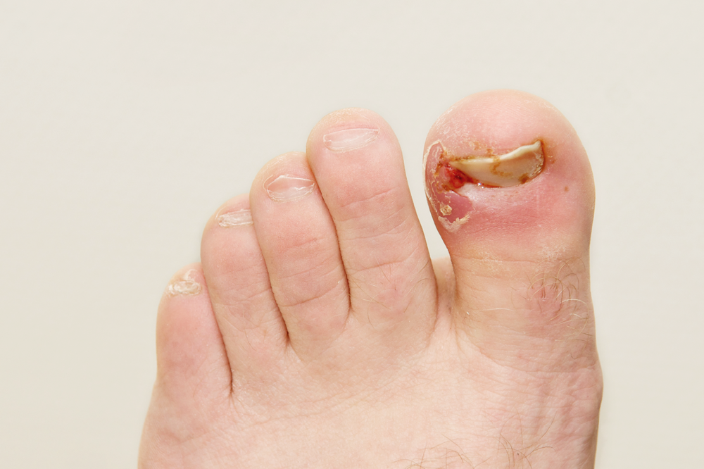 foot with a bloody ingrown toenail