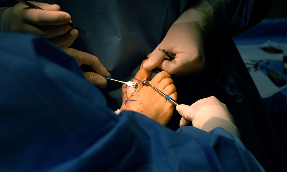 8 Mistakes Patients Make When Considering Bunion Surgery