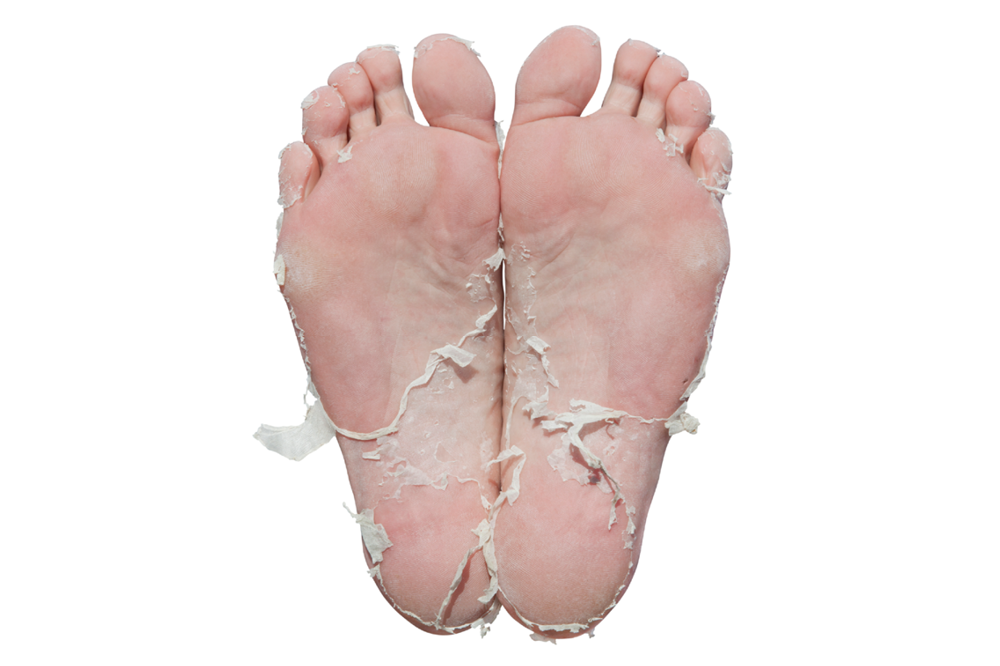Skin peeling from the use of Baby Foot Peel